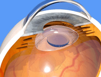 cataract